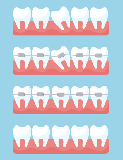 医药正畸牙套的牙齿牙齿牙痛完美